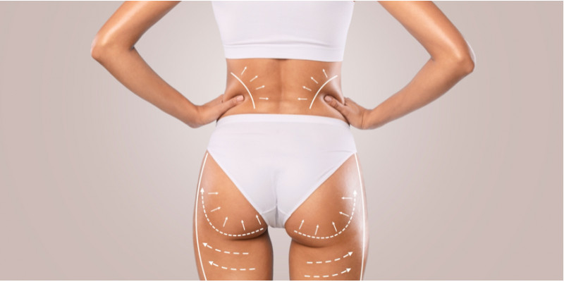 Conheça o BBL: Brazilian Butt Lift, para aumentar e modelar os glúteos